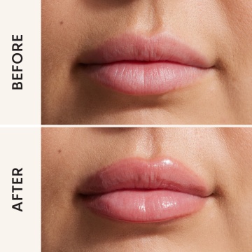 Lip Filler